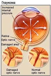 Глаукома и ваши глаза thumbnail