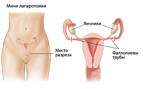 Где Находятся Яичники У Женщины Фото