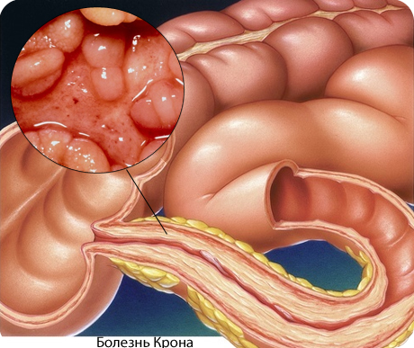 болезнь крона