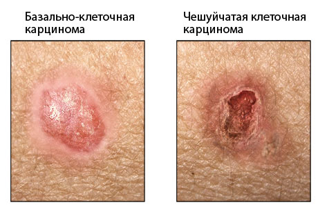 Рак кожи без меланомы Рак кожи без меланомы thumbnail