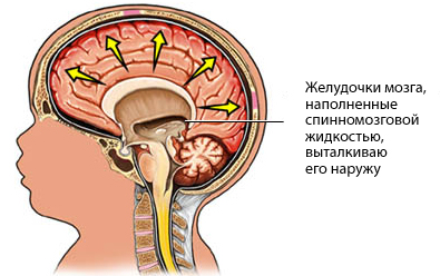 Гидроцефальный синдром у детей