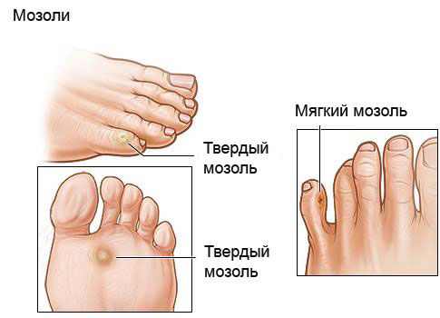 Ревматоидный артрит и натоптыши