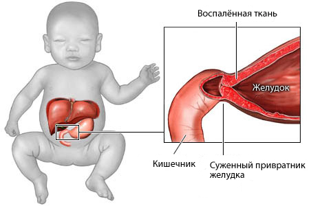 Пилоростеноз у детей