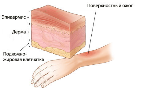 Поверхностный ожог