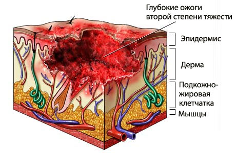 Ожоги